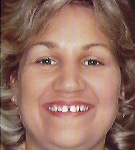 Woman with large gaps between teeth