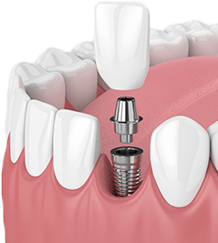 Dental implant special coupon