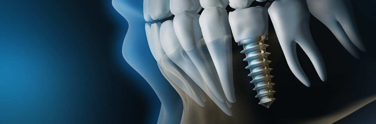 Illustrated X ray of a person with a dental implant