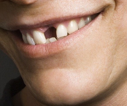 Closeup of smile with missing front tooth