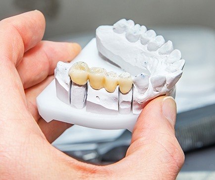 Model of the mouth with a fixed bridge