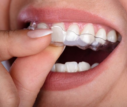 close up person inserting Invisalign tray