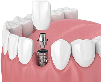 Dental implant special coupon