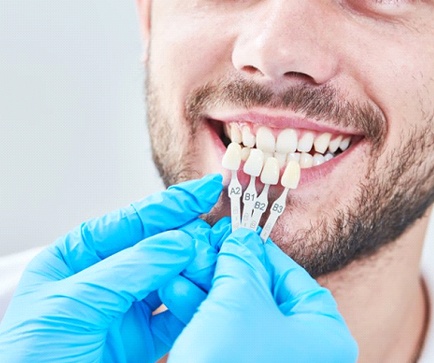 dentist holding veneers up to a patient’s smile