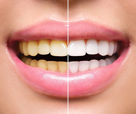 Before and after picture of teeth whitening in Mount Vernon