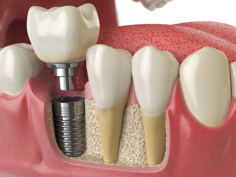 Illustration of dental implants in Mount Vernon